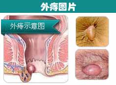 外痔图片