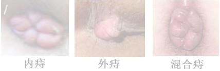 内痔外痔混合痔