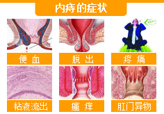 内痔的治疗