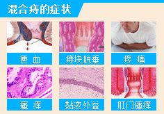 混合痔