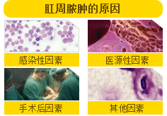肛周脓肿原因