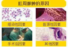 肛周脓肿的原因