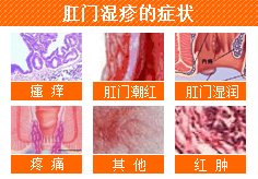 肛门湿疹症状