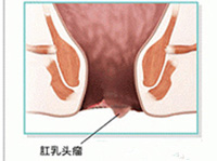 肛乳头瘤